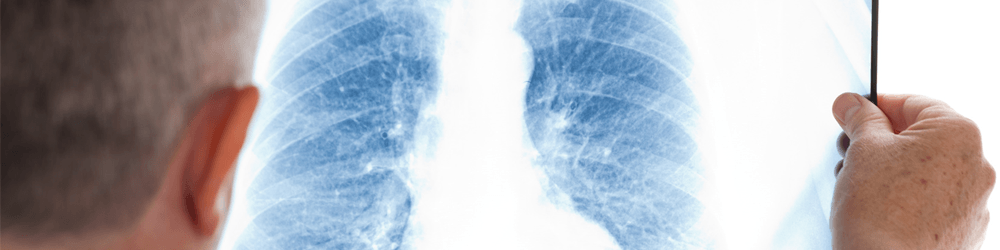 lung x-ray cancer misdiagnosis