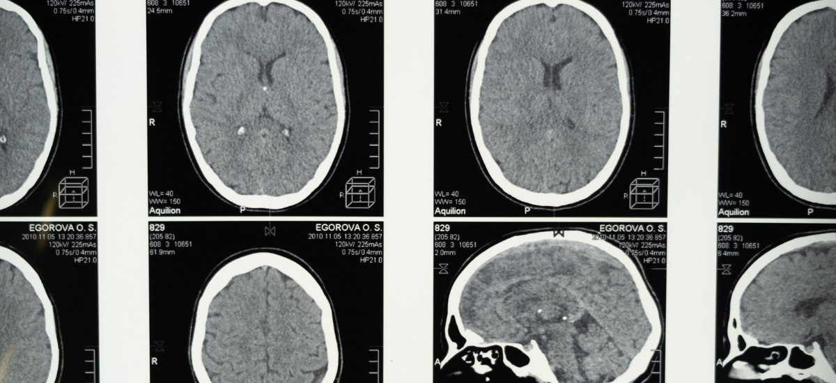 Traumatic Brain Injury Increases Risk of Chronic Disease